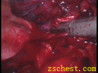 切割吻合器切右上肺尖前支动脉