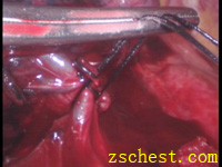 套好线后的右上肺动脉返支及叶间静脉