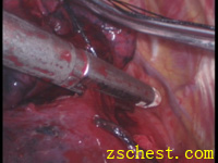 切割吻合器切断右上肺动脉返支及叶间静脉